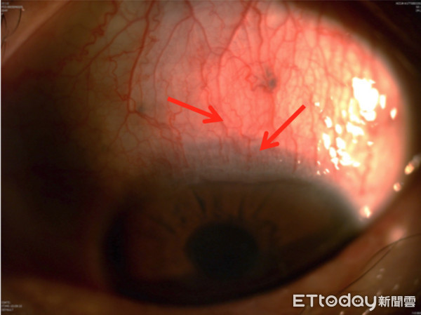 ▲長期配戴隱形眼鏡不慎需動手術。(圖/陳瑩山醫師提供)