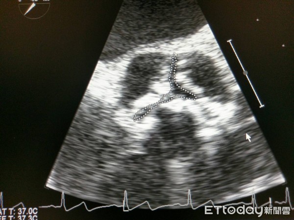 ▲走10步「休喘」肺功能全正常 原是「主動脈狹窄」在作怪。(圖/國泰醫院提供)