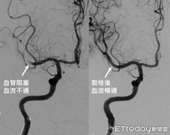 ▲婦手扶沙發失敗,機警孫救了中風嬤。(圖/陳啟仁醫師提供)