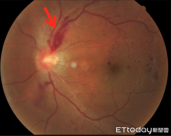 ▲眼中風。(圖/陳瑩山醫師提供)