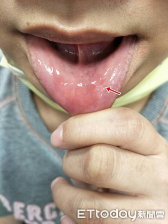 OL吃飯愛講話咬唇!冒出1cm白水泡。(圖/童綜合醫院提供)