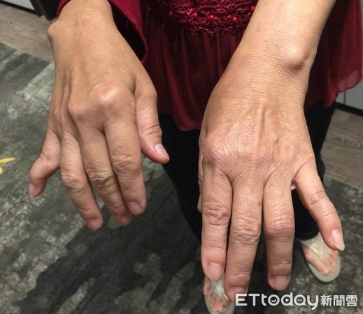 ▲▲RA病友終能重拾針棒為家人打毛衣。(圖/記者嚴云岑攝)