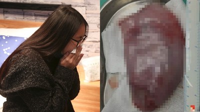 捨不得！女咳出腫瘤又「吞回肚子裡」　名醫傻：這款病人沒見過