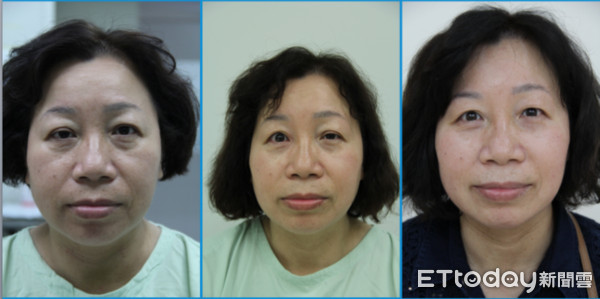 ▲雙眼皮「越來越寬」 竟是眼瞼下垂撐眼拍照還是瞇瞇眼。(圖/記者嚴云岑攝)