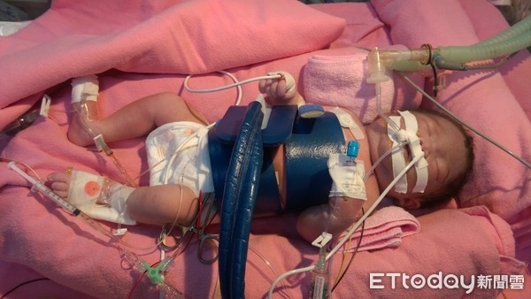 ▲生出嚴重貧血休克 竟是這病讓她「倒灌」240ml血回母體。(圖/台北榮總提供)