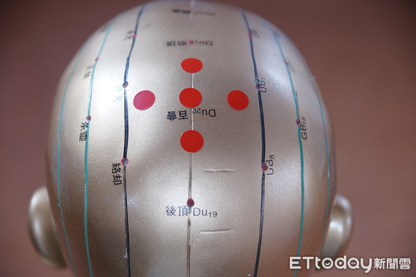 ▲失智嬤靠針灸找回自己。(圖/大林慈濟醫院提供)