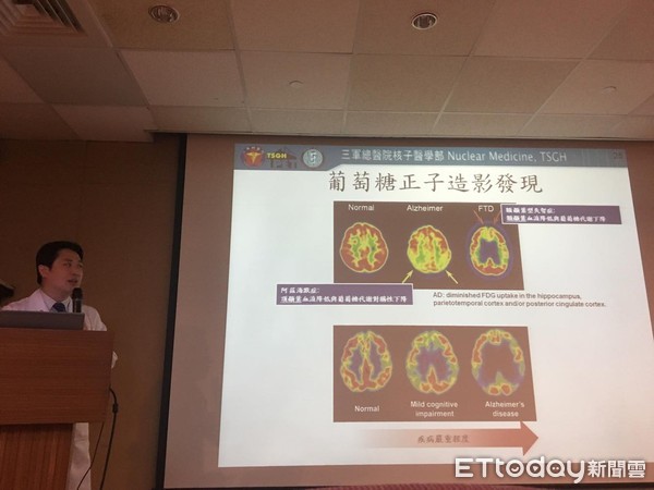 ▲失智症正子檢測。(圖/記者嚴云岑攝)