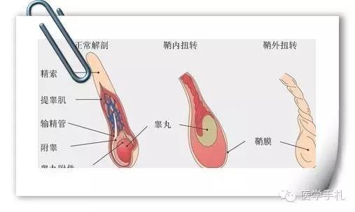 ▲▼一名父親不信任醫生，導致孩子睪丸扭轉壞死。（圖／取自「醫學手札」）