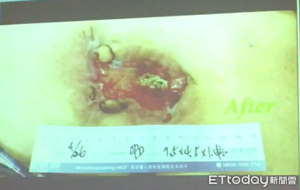 ▲淋巴癌細胞「吃穿胸骨」 他傷口如壘球大「可見心臟跳」。(圖/記者嚴云岑攝)