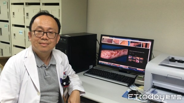 ▲彰化醫院高堅凱指出「類天皰瘡」。(圖/彰化醫院提供)