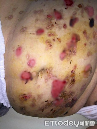 ▲水泡,膿包,類天皰瘡。(圖/彰化醫院提供)