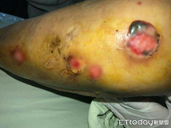 ▲水泡,膿包,類天皰瘡。(圖/彰化醫院提供)