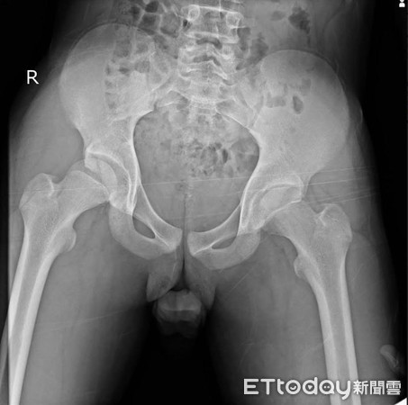 ▲少年車禍後屁股痛到走不了!年紀輕輕竟是「骨科急症」。(圖/南投醫院提供)