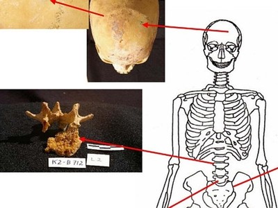 健康比古埃及差？現代人罹癌率2倍高…原來是因為活太久