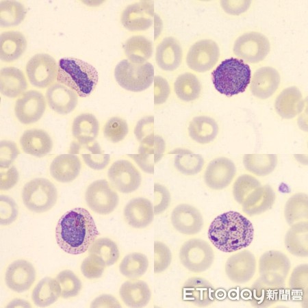 ▲間日瘧。(圖/疾管署提供)