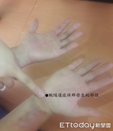 ▲腕隧道症候群。(圖/長庚醫院提供)