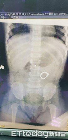 ▲女童誤吞巴克球。(圖/童綜合醫院提供)