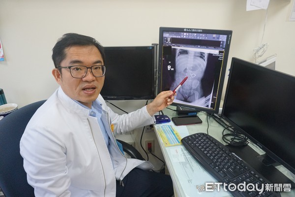 ▲女童誤吞巴克球。(圖/童綜合醫院提供)