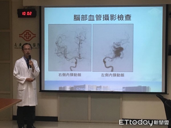 ▲27歲粉領族「爆炸性頭痛」 竟是「血管畸形」釀中風。(圖/記者嚴云岑攝)