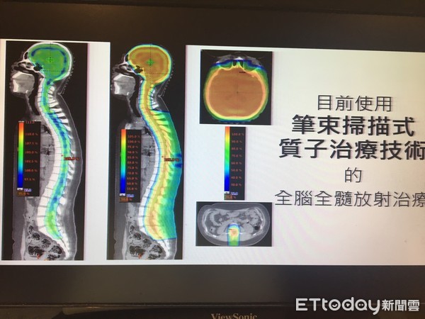 ▲11歲童頭痛到吐 竟是「惡性脈絡叢瘤」在大腦爆炸了。(圖/記者嚴云岑攝)