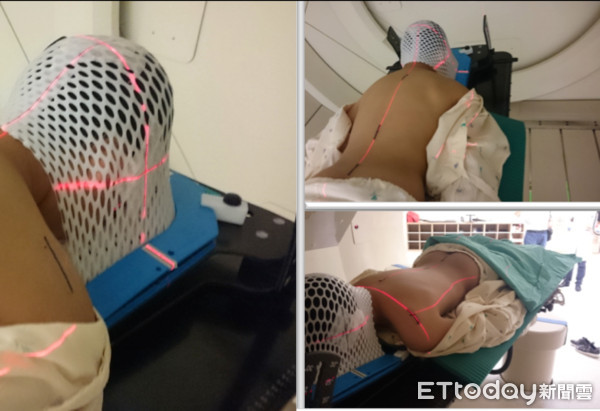 ▲陳小弟接受質子治療。(圖/長庚醫院提供)
