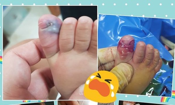 ▲▼剪傷腳趾甲。(圖/翻攝自เรื่องเล่าจากโรงหมอ臉書)