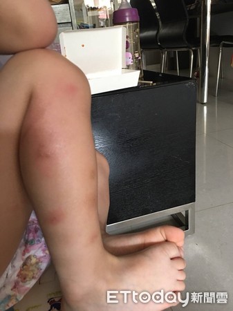 ▲▼小娟小女兒的腿上還留有被熱水燙過的疤痕。（圖／記者唐詠絮攝）