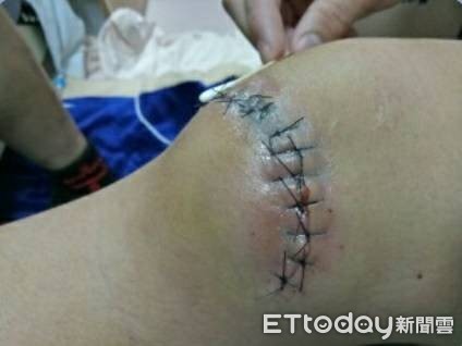 ▲克服賽前車禍傷勢 堅強出賽挑戰不可能的任務。(圖/長庚醫院提供)