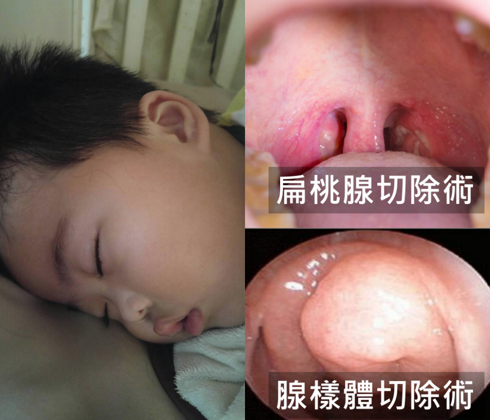 ▲5歲童打鼾超大聲 睡覺只能「嘴開開」原是這2處塞住了(圖/雙和醫院提供)