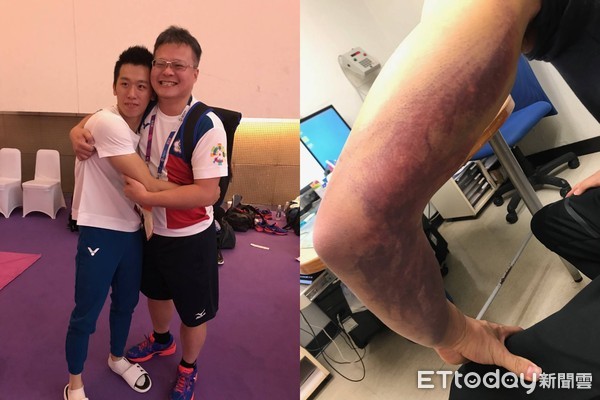 ▲李智凱克服肩傷 用意志力短期復原。(圖/長庚醫院提供)