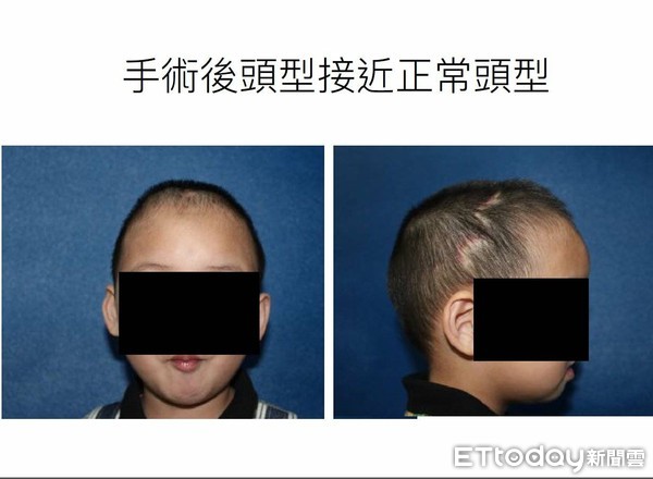 ▲睡壞了?男童頭超尖像「鹹蛋超人」 竟是顱縫早閉惹禍。(圖/長庚醫院提供)