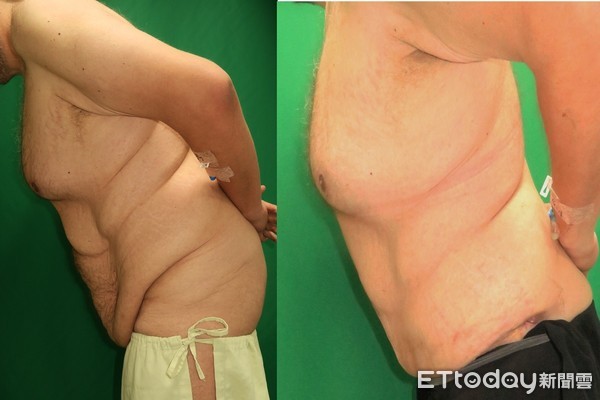 ▲▼大同醫院整形外科主任沈彥廷提供。
