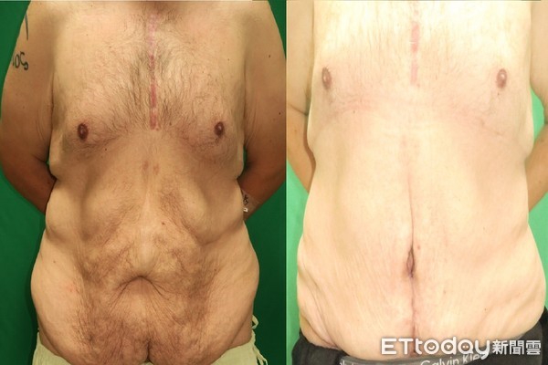▲▼大同醫院整形外科主任沈彥廷提供。
