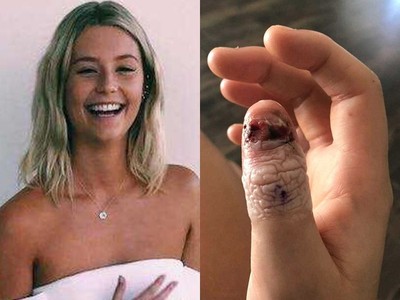 「咬指甲成癮」罹癌！20歲女咬下整塊大拇哥甲片，塗指甲油藏爛肉