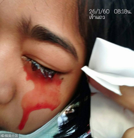 泰國女童得血色病（hematohidrosis）。（圖／CFP）