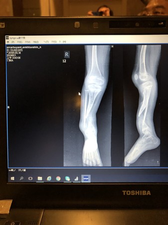 ▲▼台灣醫療團跨海蒙古義診,長短腳沒腿骨9歲男童將安排到台灣接受治療。(圖/員榮醫療體系員榮醫院提供,以下同)