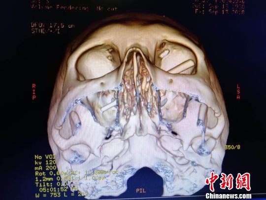 ▲▼重慶男子酒後「斷片」，筷子插進眼眶3天才發現。（圖／取自《中新網》）