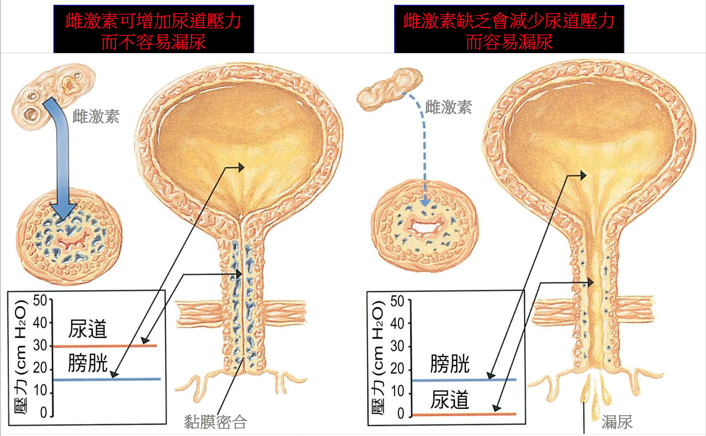 ▲尿失禁原因。(圖/陳怡仁醫師提供)