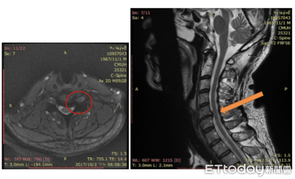 ▲椎間盤突出。(圖/中國附醫提供)