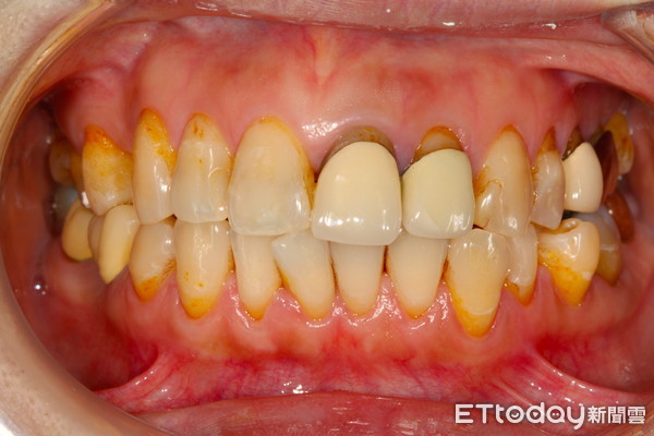 ▲▼喝珍奶慘變大餅臉!妙齡OL天天咬珍珠...咀嚼肌發炎痛爆。(圖/中壢天晟醫院提供)