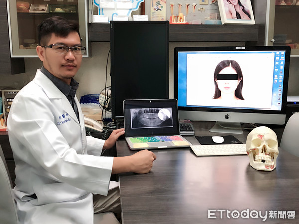 ▲▼喝珍奶慘變大餅臉!妙齡OL天天咬珍珠...咀嚼肌發炎痛爆。(圖/中壢天晟醫院提供)