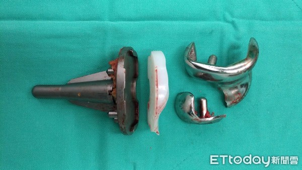 ▲▼八旬嬤人工關節斷裂。(圖/南投醫院提供)