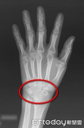 教課太認真!鋼琴老師3指難抬起 竟是這病害她「肌腱斷」。(圖/台北慈濟醫院提供)