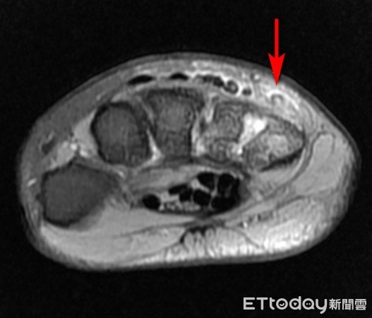 教課太認真!鋼琴老師3指難抬起 竟是這病害她「肌腱斷」。(圖/台北慈濟醫院提供)