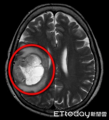 全身癱瘓非中風，竟是腦瘤作怪。（圖／台北慈濟醫院提供）