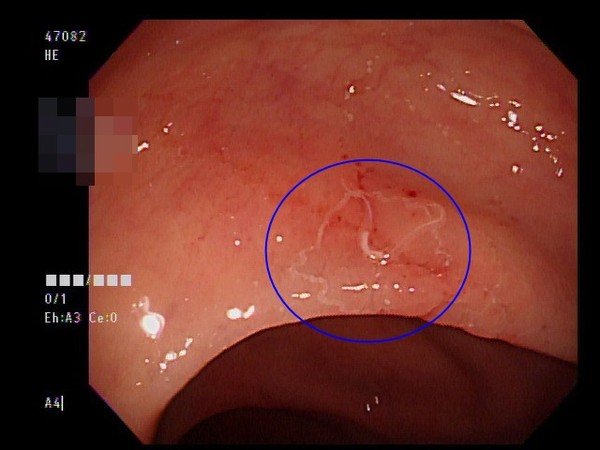 ▲▼登山客暢飲沁涼山泉水 肚痛就醫檢查竟拉出鉤蟲。(圖/亞洲大學附屬醫院提供)