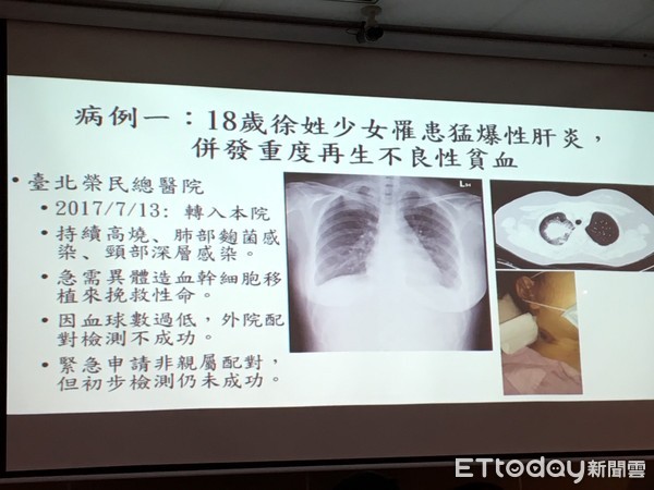 ▲猛爆性肝炎併多重感染 父捐「半相合造血幹細胞」救獨生女。(圖/記者嚴云岑攝)