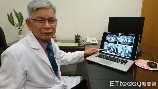 ▲▼肚子痛!她內臟長5公分「血香菇」 醫:沒弄好恐洗腎。(圖/童綜合醫院提供)