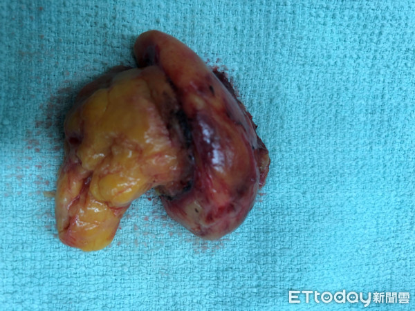 ▲▼肚子痛!她內臟長5公分「血香菇」 醫:沒弄好恐洗腎。(圖/童綜合醫院提供)