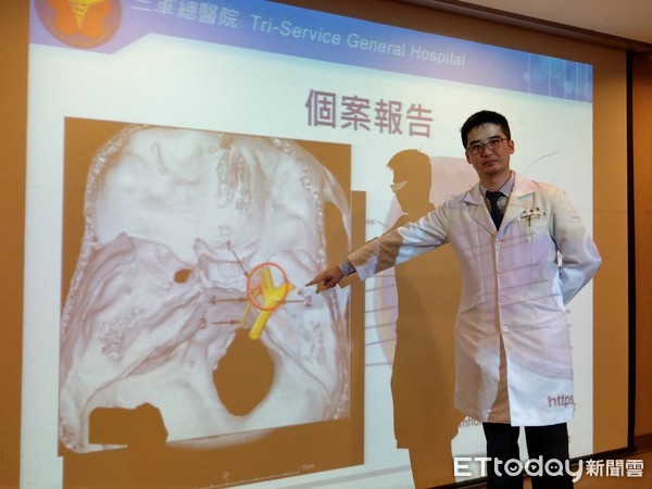 ▲中耳炎吃藥未癒還複視、臉麻 原是「罕菌」沿耳道入侵大腦。(圖/三總提供)